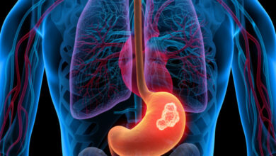 Cáncer gástrico: Causas, factores de riesgo y síntomas