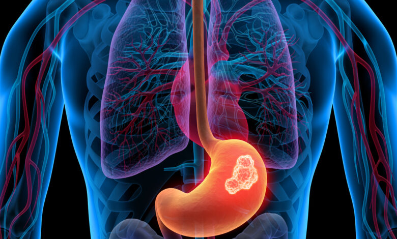 Cáncer gástrico: Causas, factores de riesgo y síntomas