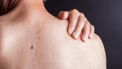 Carcinoma epidermoide