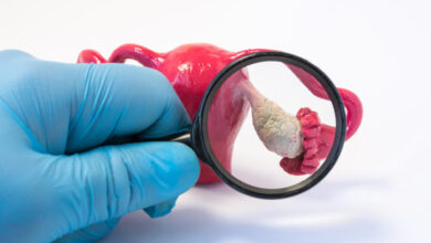 Cómo reducir el riesgo de cáncer de ovario