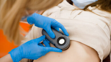 Factores de riesgo y prevención del melanoma