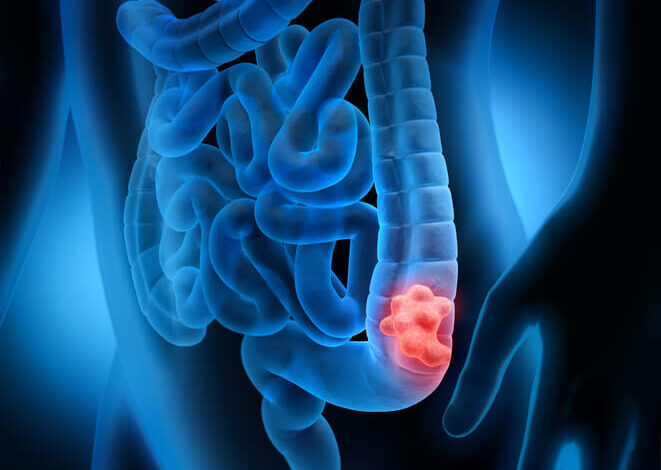 Lo que necesita saber sobre cáncer de colon