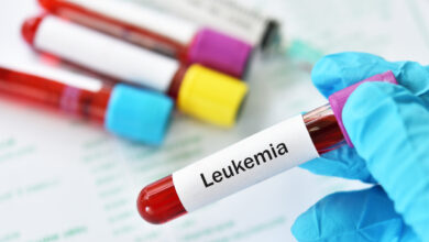 Conoce qué es la leucemia mieloide aguda