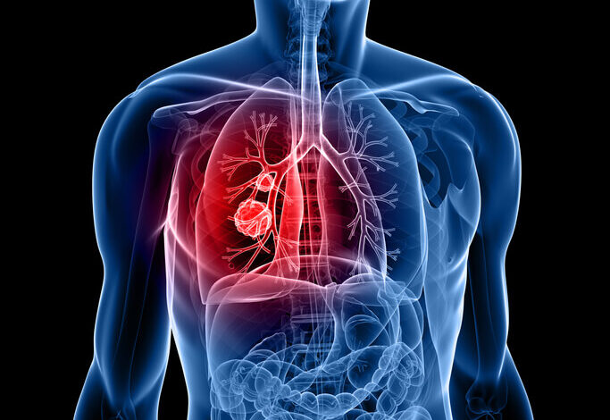FDA aprueba LUMAKRAS, primer y único tratamiento para cáncer de pulmón