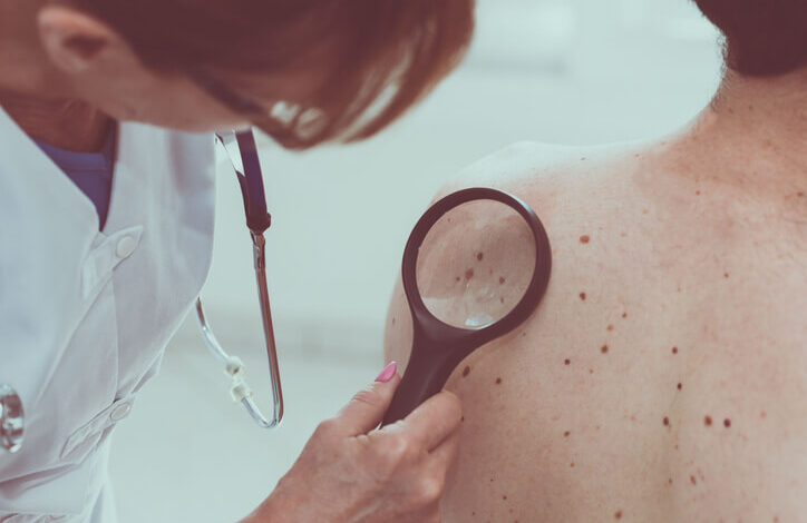 Cómo reconocer a tiempo el cáncer de piel
