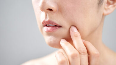 Cómo se manifiestan y se tratan las queratosis actínicas
