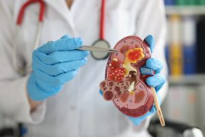 Cáncer de riñón: supervivencia a cinco años es de un 76%