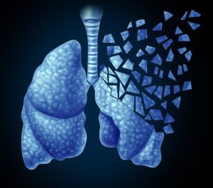 Cáncer de pulmón de células no pequeñas: crecen tasas de supervivencia