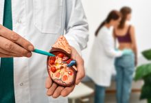 El cáncer de riñón es un cáncer que comienza en los riñones. Los riñones son dos órganos con forma de frijoles.
