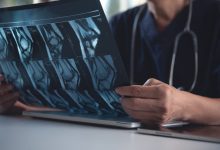 Algunos tipos de cáncer primario de hueso son el osteosarcoma, el sarcoma de Ewing, el histiocitoma fibroso maligno y el condrosarcoma.