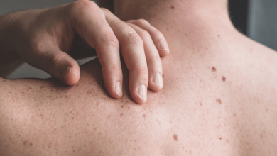 Lesiones cutáneas en cáncer