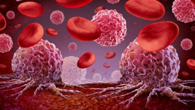Encuentra respuestas claras y concisas a las preguntas más comunes sobre la leucemia mieloide aguda (LMA) en esta guía esencial.