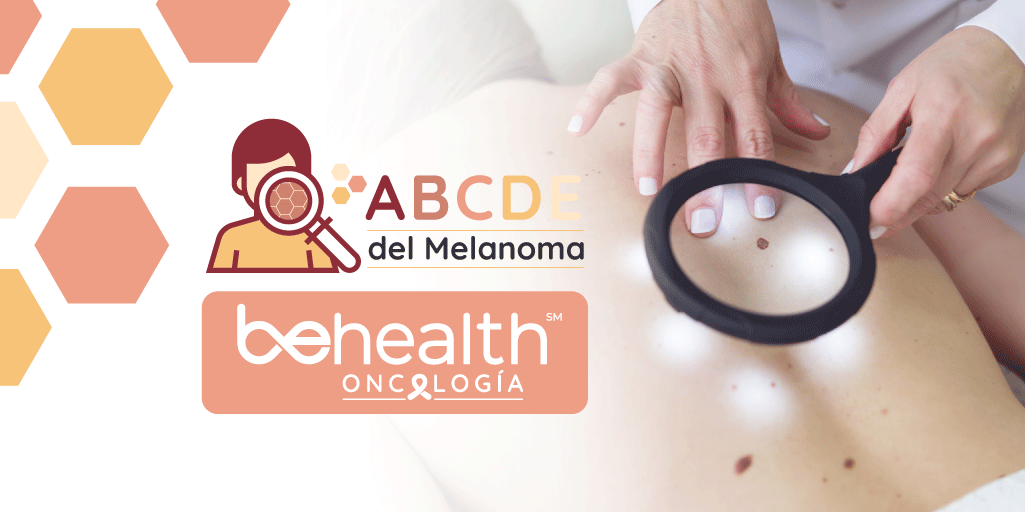 imagen destacada de abcde del melanoma de oncología