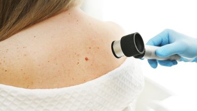 Melanoma