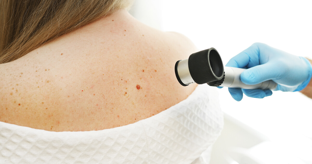 Melanoma