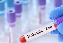 Tratamiento para la leucemia con alta tasa de supervivencia