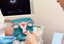 Cáncer de endometrio vs. cáncer de útero: ¿hay diferencia?