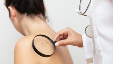 Cáncer de piel
