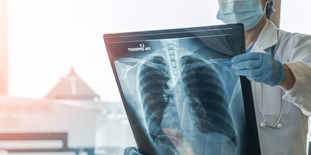 ADN humano devela vínculo entre la contaminación y el cáncer de pulmón entre no fumadores