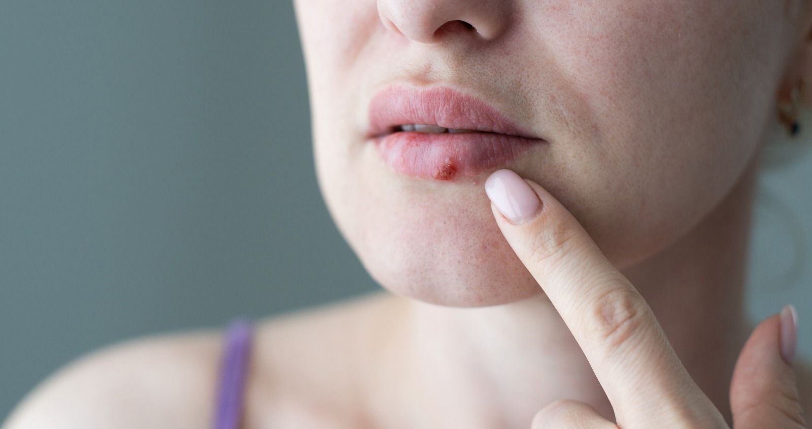 El virus del herpes está siendo modificado por científicos para convertirse en un poderoso aliado en la lucha contra el cáncer