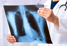 El MSK advierte sobre la alta incidencia en adultos jóvenes sin antecedentes de tabaquismo diagnosticados con cáncer de pulmón.