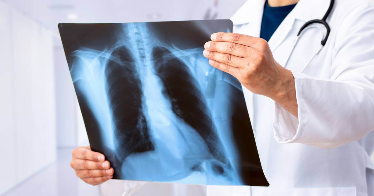 El MSK advierte sobre la alta incidencia en adultos jóvenes sin antecedentes de tabaquismo diagnosticados con cáncer de pulmón.