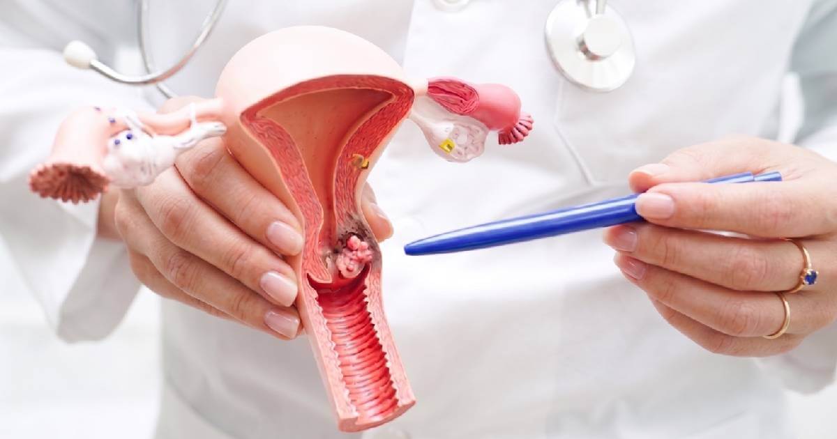 El CCCUPR invita a mujeres entre los 25 y 65 años de Puerto Rico y que no estén al día con sus pruebas para la prevención de cáncer cervical.