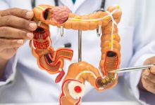 Una preocupación inminente entre la comunidad médica y oncológica sobre el aumento de muertes por cáncer rectal en pacientes jóvenes.
