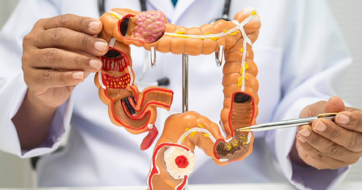 Una preocupación inminente entre la comunidad médica y oncológica sobre el aumento de muertes por cáncer rectal en pacientes jóvenes.