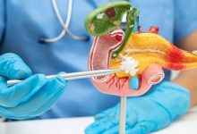 La Sociedad Americana Contra el Cáncer estima que en 2026 el cáncer de páncreas en Estados Unidos será de 67,530 personas diagnosticadas.