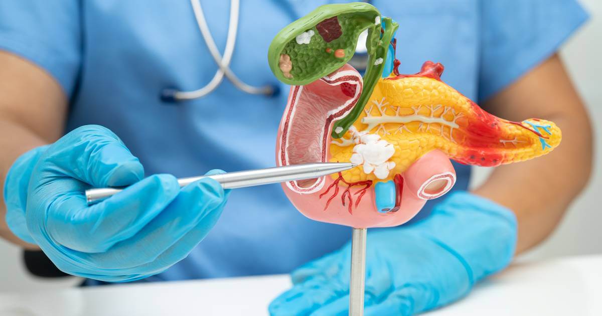 La Sociedad Americana Contra el Cáncer estima que en 2026 el cáncer de páncreas en Estados Unidos será de 67,530 personas diagnosticadas.
