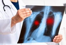 Según cifras del Registro Central de Cáncer, entre el 2018 y 2022 un promedio anual de 759 personas fueron diagnosticadas con cáncer de pulmón