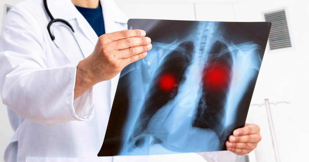 Según cifras del Registro Central de Cáncer, entre el 2018 y 2022 un promedio anual de 759 personas fueron diagnosticadas con cáncer de pulmón